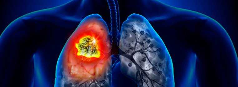 Ilustração que mostra o que acontece na trombose pulmonar