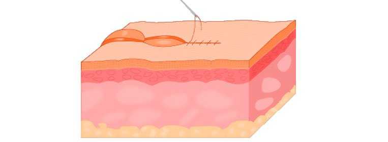 ponto aberto cirurgia