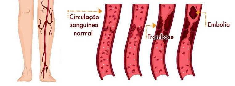 Ilustração que mostra e evolução de uma trombose na perna, com a formação de um coágulo, que vira um êmbolo