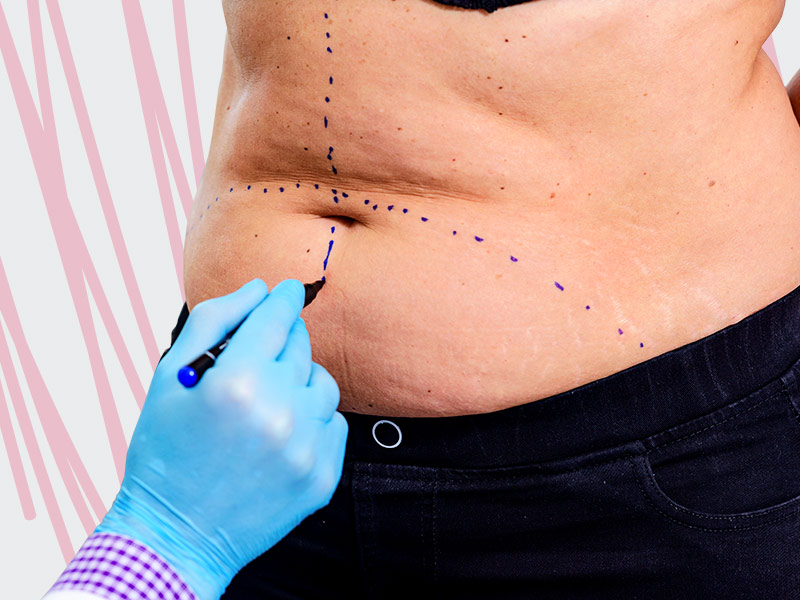 mulher recebendo marcação na barriga para fazer dermolipectomia