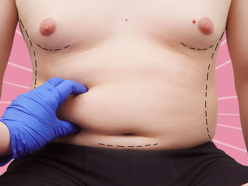 cirurgião avaliando necessidade de cirurgia dermolipectomia masculina