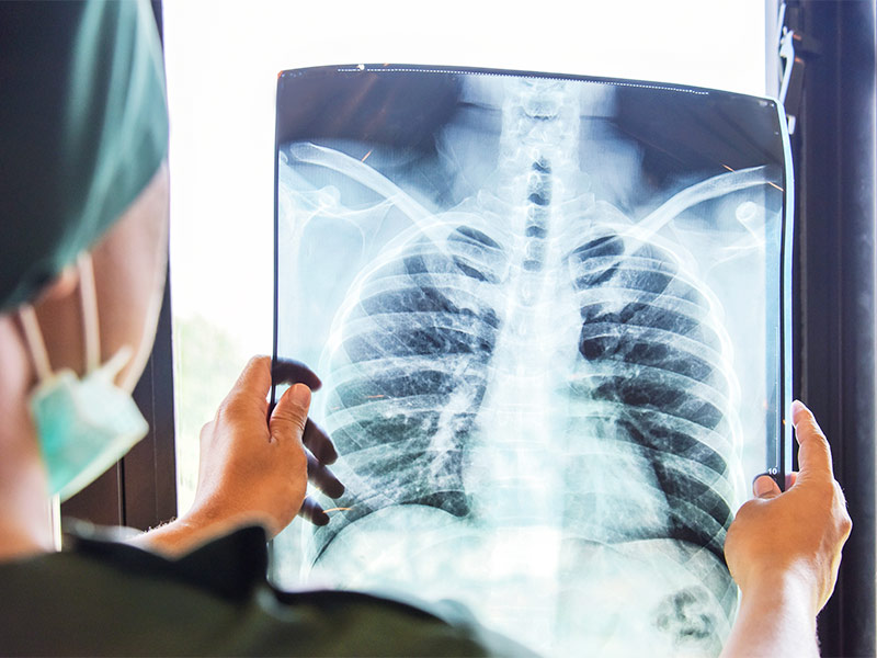 Médico olhando um raio X, para fazer o diagnóstico do tromboembolismo pulmonar