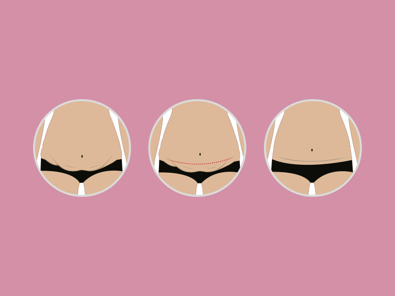 Passo a passo da dermolipectomia ilustração explicando como é feita dermolipectomia abdominal