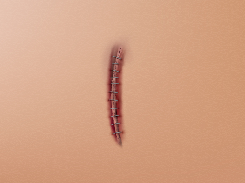É normal o seroma ter sangue? Ilustração de seroma com sangue