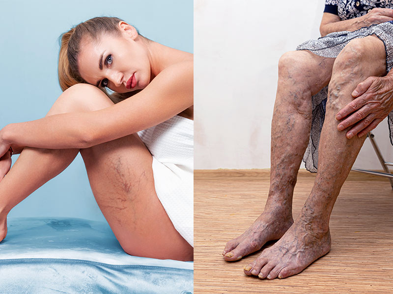 Duas imagens, uma que mostra a trombose na perna em uma jovem e uma idosa