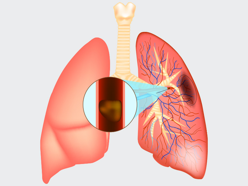 Ilustração que mostra o que causa a embolia pulmonar, um coágulo de sangue