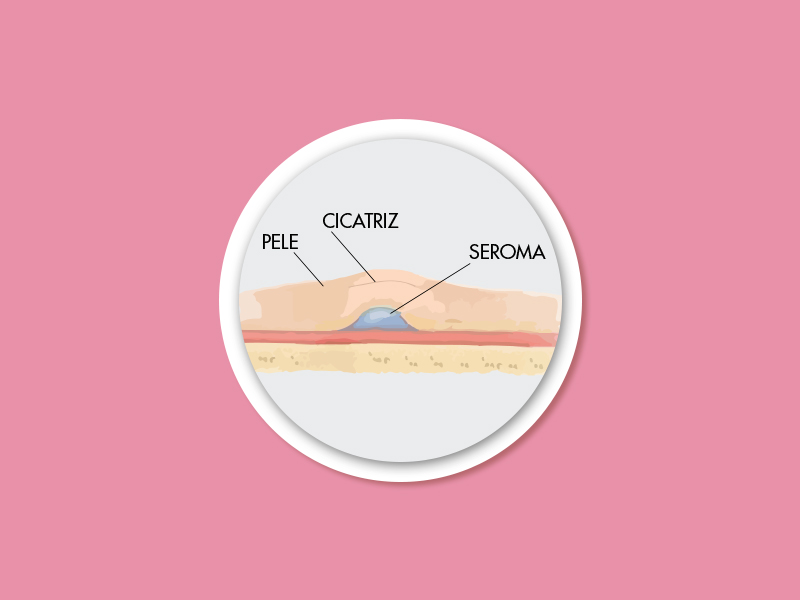 Illustração que mostra como fica o seroma encapsulado embaixo da cicatriz