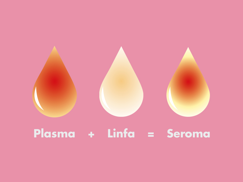 Ilustração que mostra como que causa seroma, com a mistura de plasma e finfa