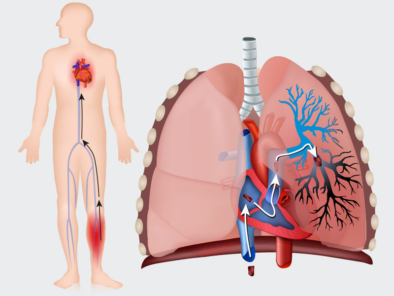 Ilustração que mostra as sequelas da embolia pulmonar no corpo