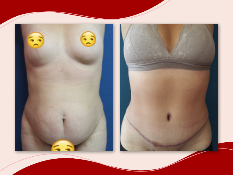 foto de antes e depois de uma cirurgia de abdominoplastia, onde na primeira foto é possível ver uma barriga flácida e na segunda um abdômen mais marcado e sem flacidez