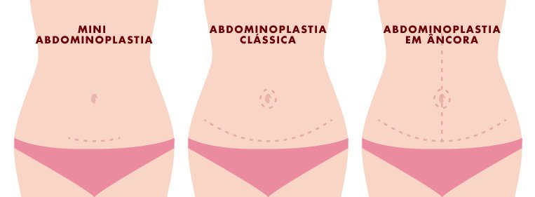 Qual é o tamanho da cicatriz de abdominoplastia?