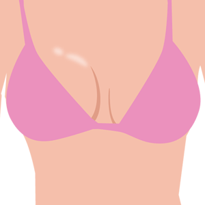 Pode Acontecer o Deslocamento de Prótese de Silicone? Sintomas Desvendados Por Especialistas