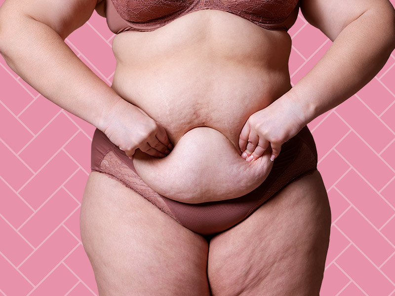 Pele flácida em excesso no abdômen mulher mostrando a barriga avental