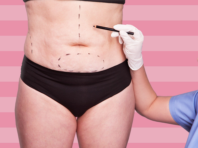 Como é feito o umbigo na abdominoplastia