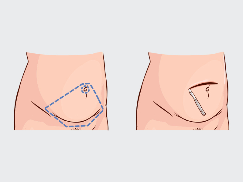 como fica o umbigo depois da abdominoplastia