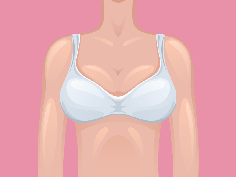 O que é simastia na prótese de silicone? Outro tipo de deslocamento? simastia protese silicone