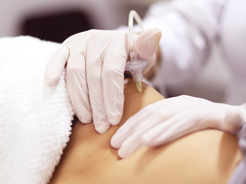 Carboxiterapia para flacidez na barriga mulher fazendo carboxiterapia flacidez barriga