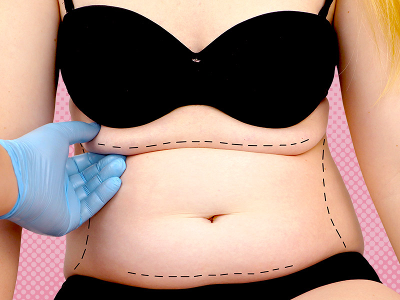 Cirurgia de flacidez na barriga mulher com marcação da cirurgia flacidez barriga