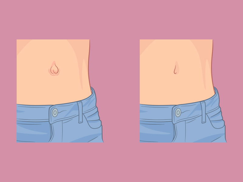 correção de umbigo após abdominoplastia