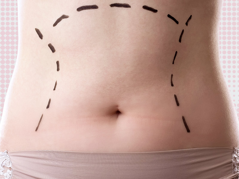 Será que o valor da lipoaspiração em SP é realmente “alto”? valor lipoaspiracao sp