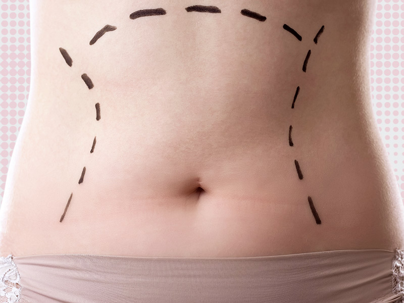 Imagem de uma barriga feminina com marcações que antecedem uma cirurgia plástica
