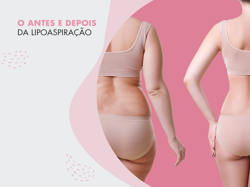 Lipoaspiração antes e depois: resultados de lipo na barriga, costas, flancos e culotes para você se inspirar! lipoaspiracao antes depois