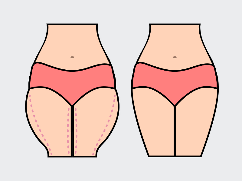 Ilustração mostrando o antes e depois da lipoaspiração nas coxas