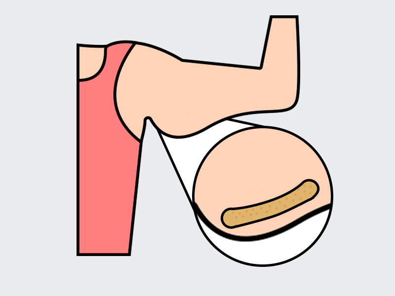 Ilustração mostrando a região onde é feita a lipo no braço