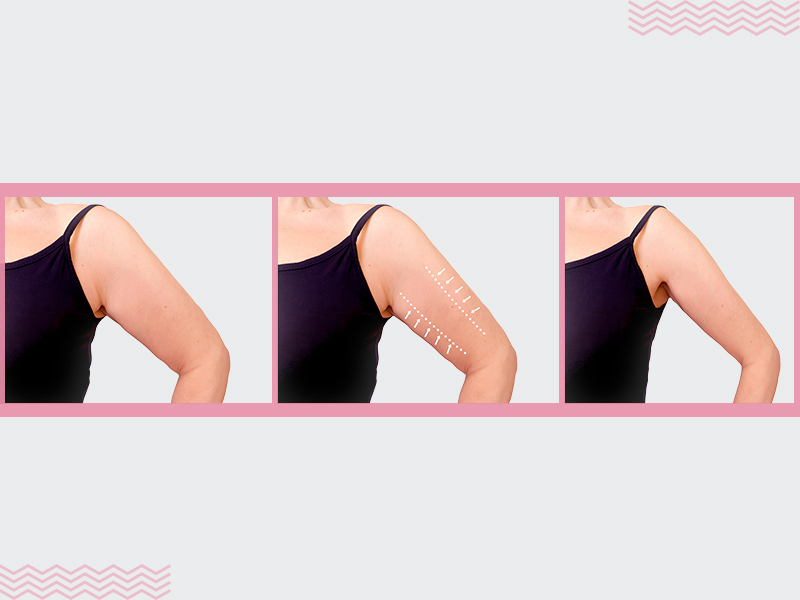 Resultado da lipoaspiração nos braços! lipoaspiracao braco antes depois