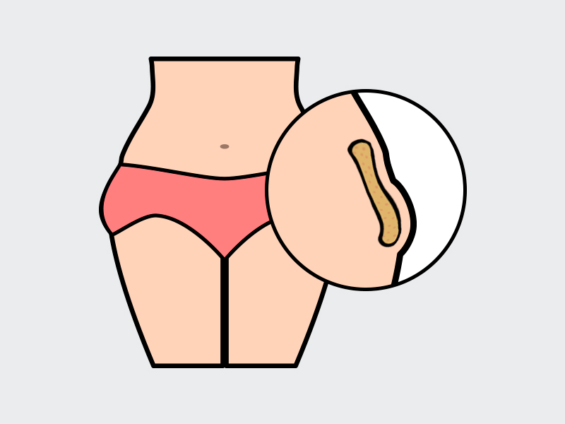 Ilustração mostrando o acúmulo de gordura no culote