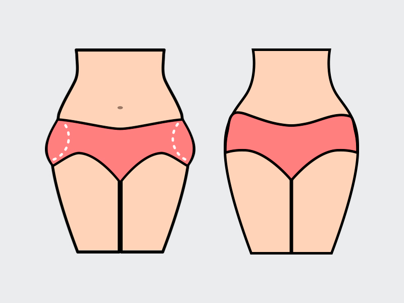 Ilustração mostrando o antes e depois da lipo no culote