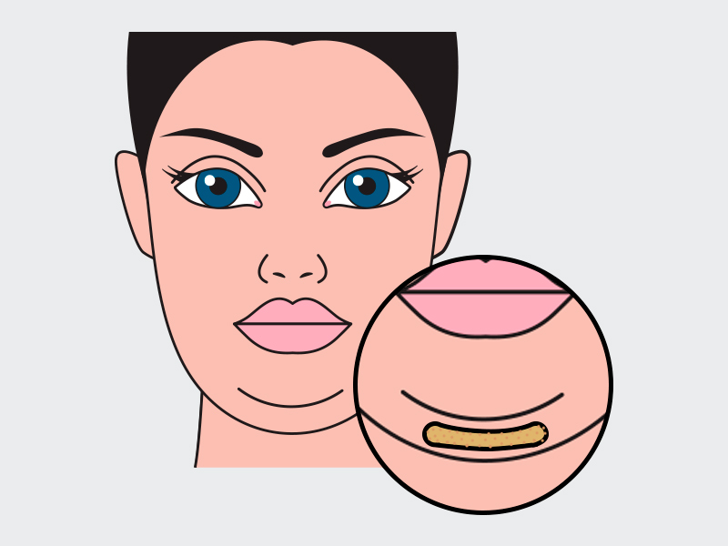 O antes e depois da lipo de submento lipo submento antes depois