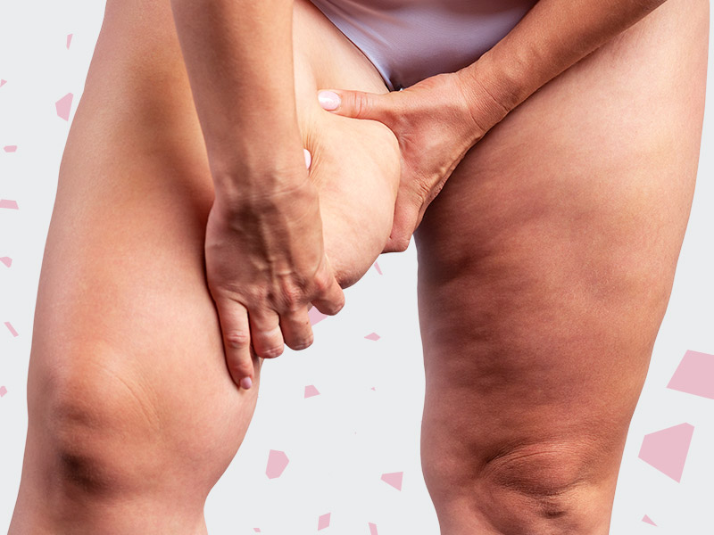 Quanto custa uma lipo das coxas? Imagem de uma mulher segurando a gordura localizada na coxa para ilustrar o tema "quanto custa uma lipoaspiração nas coxas"