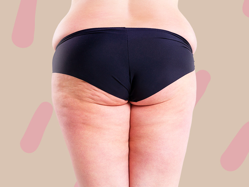 Imagem de uma mulher de costas, com destaque para a gordura localizada na região dos quadris, a fim de ilustrar o tema "valor da lipoaspiração nos flancos"
