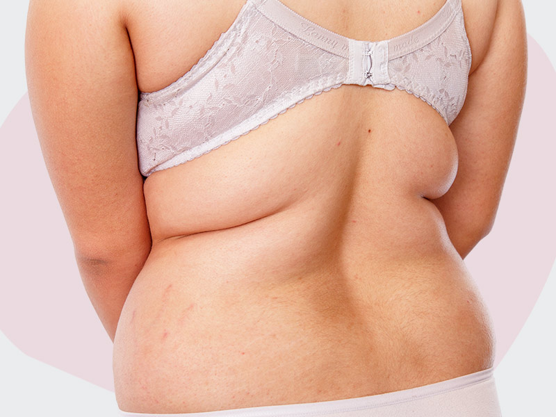 Imagem de uma mulher de costas, com destaque para a gordura localizada nessa região, a fim de ilustrar o tema "preço da lipo nas costas"
