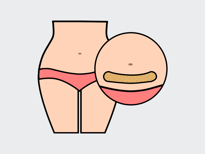 Ilustração mostrando o acúmulo de gordura na região do abdômen