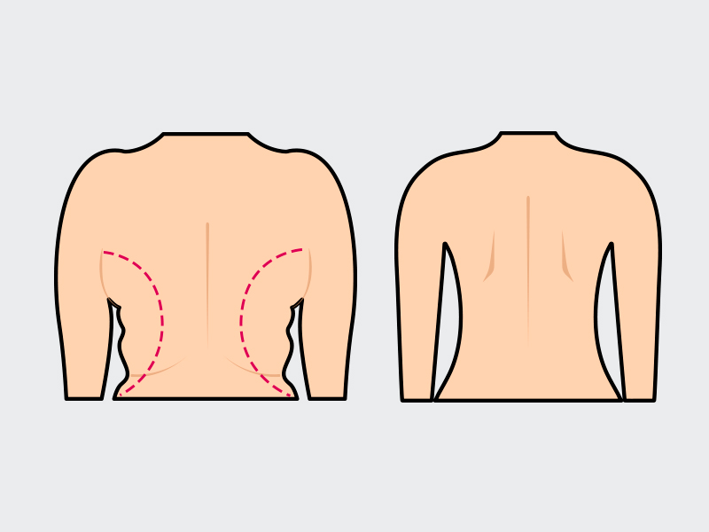 Ilustração mostrando o antes e depois da lipoaspiração nas costas