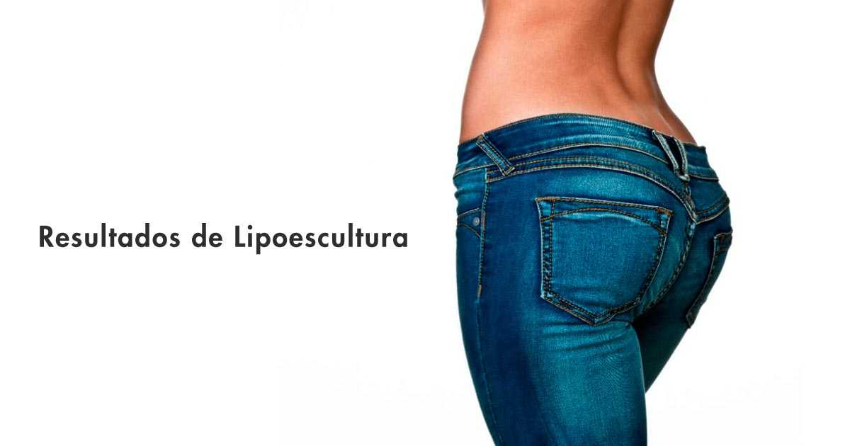 Antes E Depois De Enxerto De Gordura No Gluteo Lipoescultura antes e depois | Confira aqui Dream Plastic