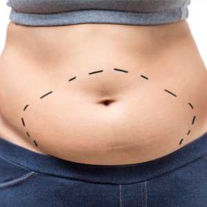 Vídeos de cirurgia de abdominoplastia e 8 dicas que os médicos não falam, mas você precisa saber antes de operar