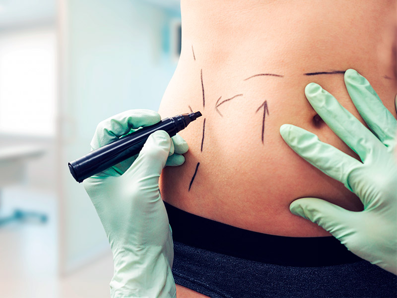 cirurgiã marcando onde fará a mini lipo na barriga