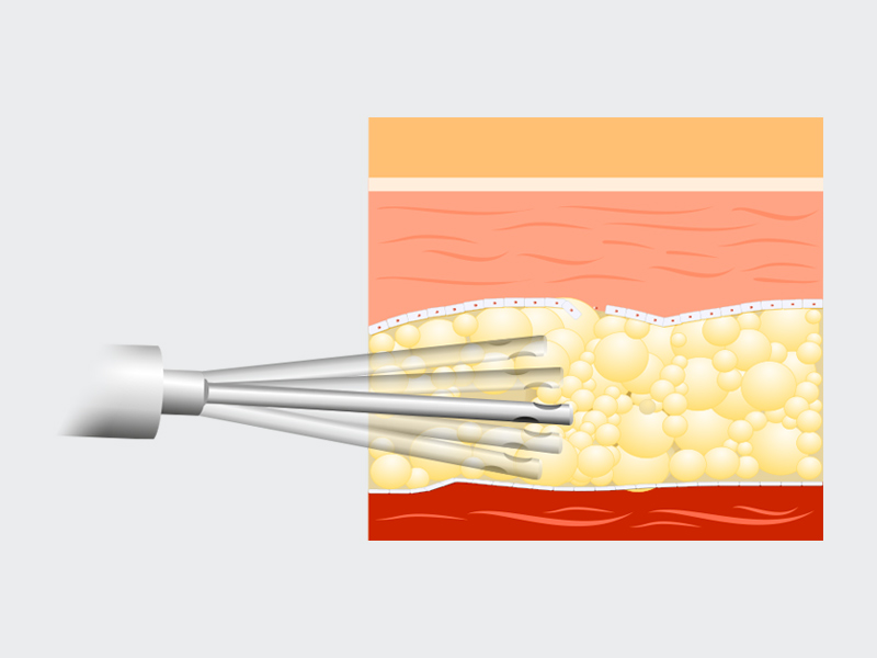 Ilustração mostrando como é feito a vibrolipo para a retirada de gordura localizada na barriga