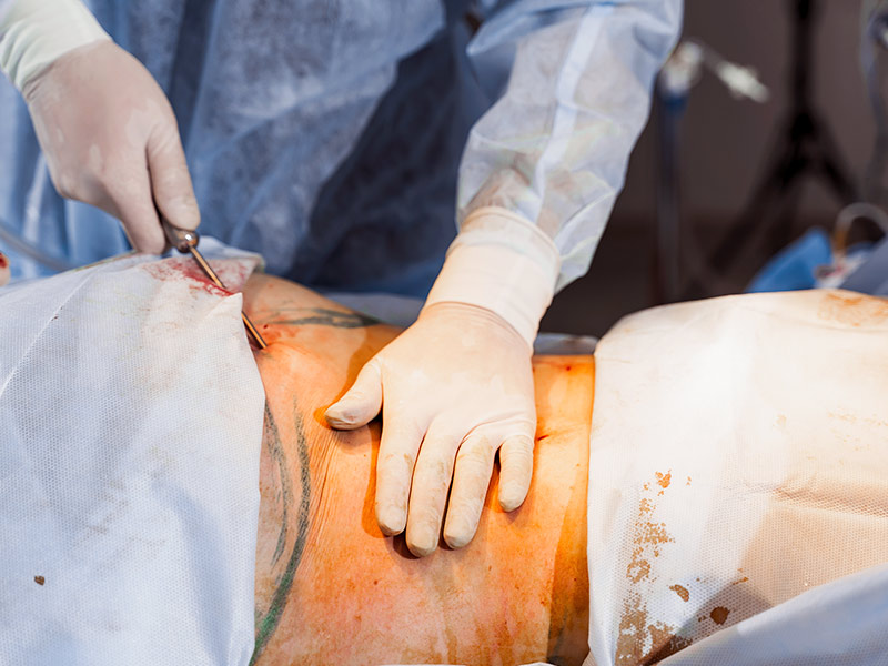 O que é hidrolipo? hidrolipoclasia aspirativa