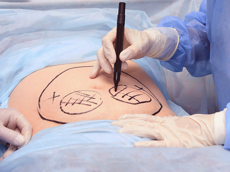 Como é feita a hidrolipo como funciona cirurgia hidrolipo