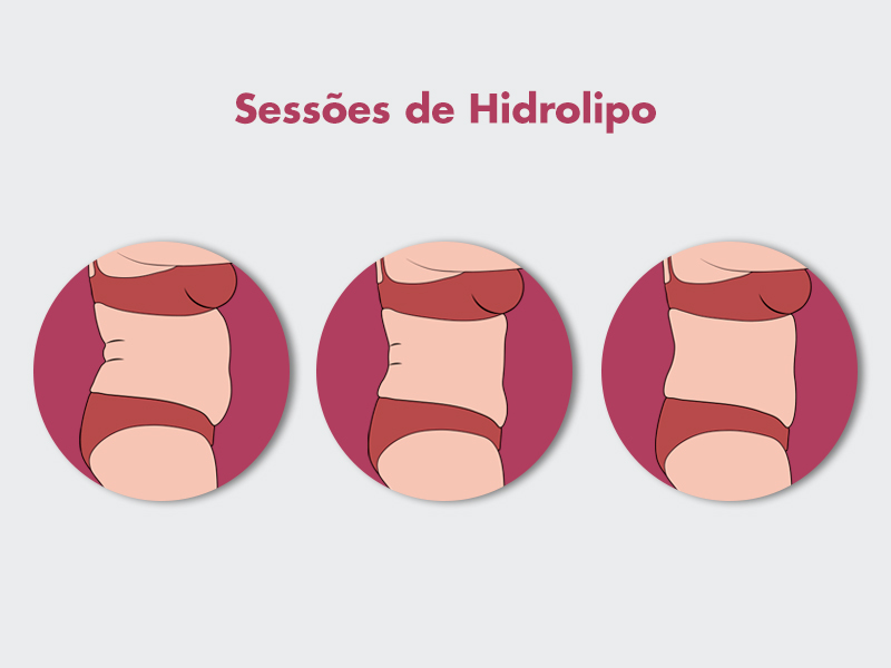 Ilustração mostrando o antes e depois hidrolipo após algumas sessões