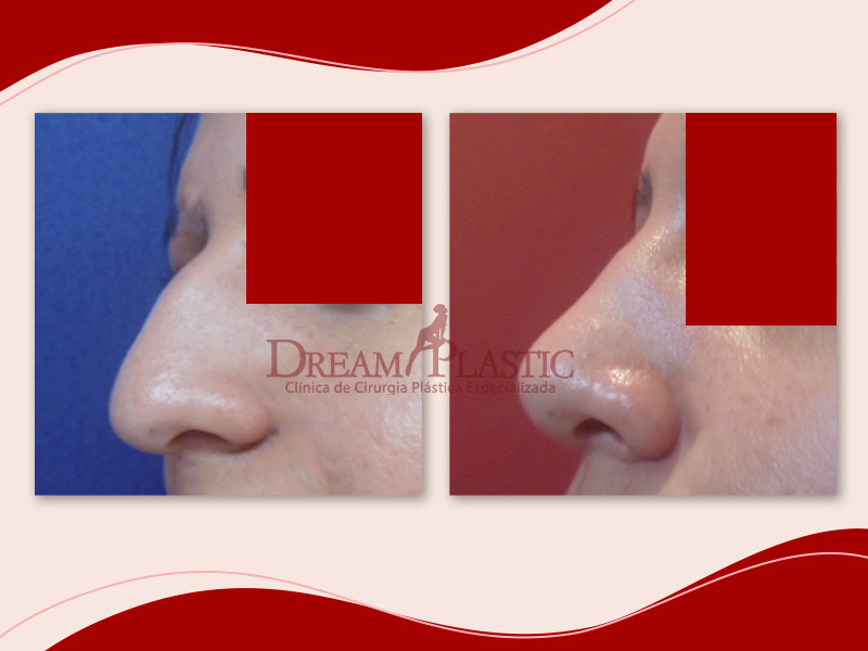 Antes e depois da rinoplastia em nariz grande e largo