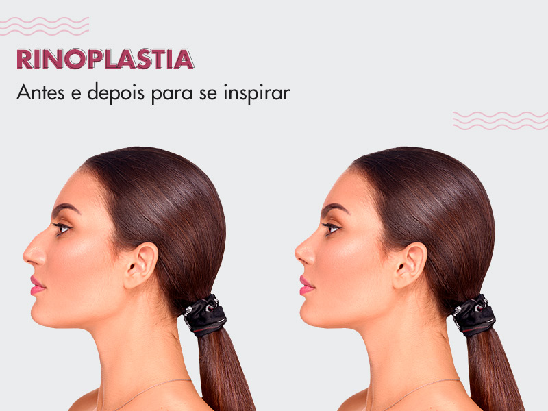 Rinoplastia antes e depois: fotos e dicas para você conquistar o melhor resultado rinoplastia antes depois