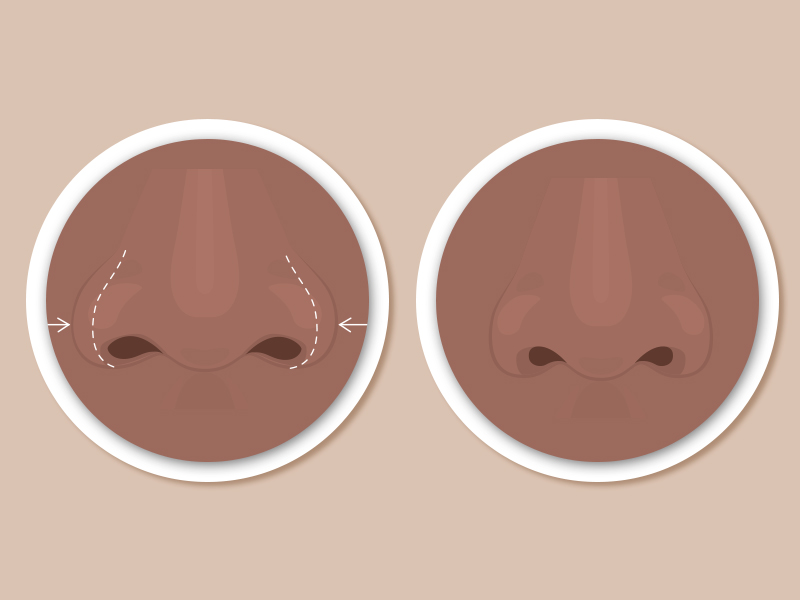 Ilustração com o antes e depois da rinoplastia em nariz batata