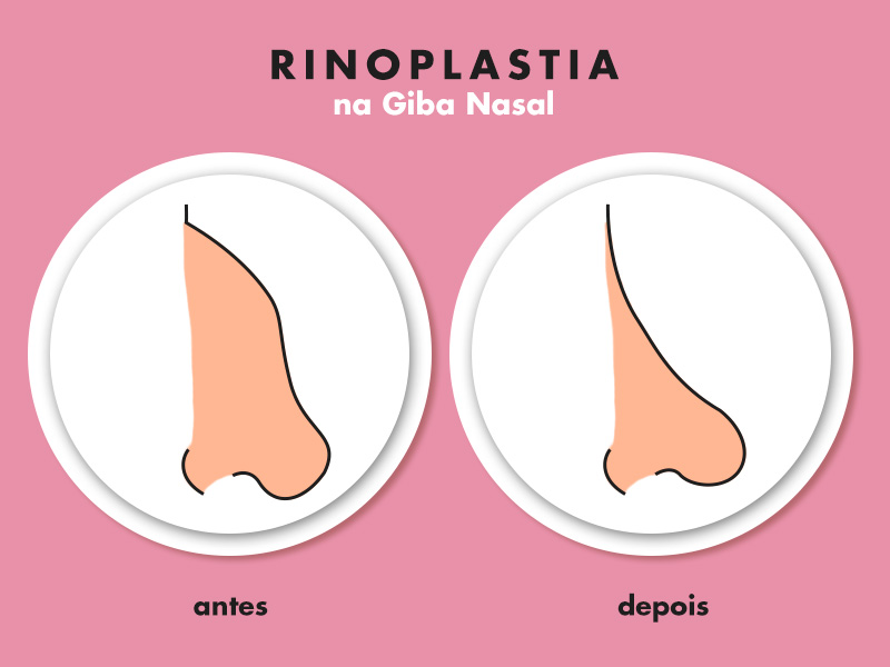 Ilustração com o antes e depois da rinoplastia em nariz grande e com giba nasal