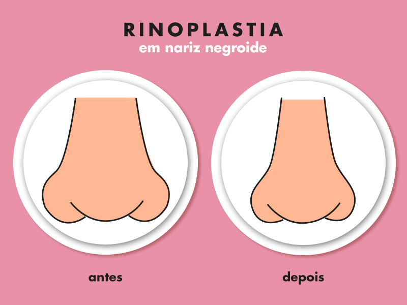 Ilustração com o antes e depois da rinoplastia em nariz negroide