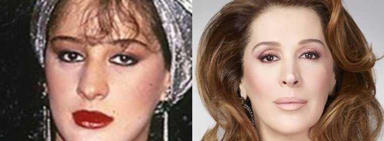 antes e depois rinoplastia